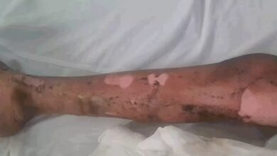 सेंट विसेंट पलोटी स्कूल में सोडियम ब्लास्ट में बच्ची झुलसी