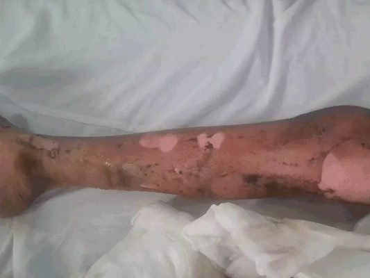 सेंट विसेंट पलोटी स्कूल में सोडियम ब्लास्ट में बच्ची झुलसी