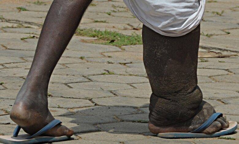 भारत में फाइलेरिया: हाथीपांव जैसी बीमारी से लाखों लोग प्रभावित, जाने कैसे होती है ये बीमारी 1 ele