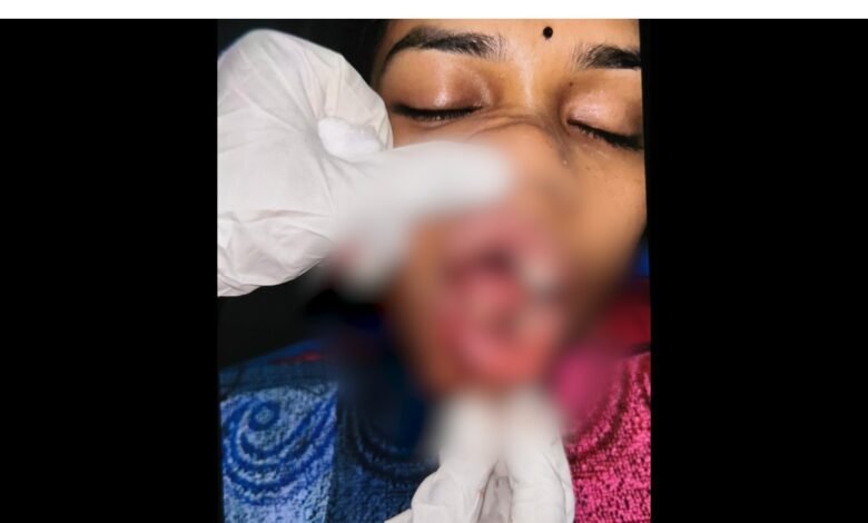 Stone-pelting: बिलासपुर में कार पर पथराव: एमपी की युवती गंभीर रूप से घायल, सिम्स रेफर. 1 Stone-pelting