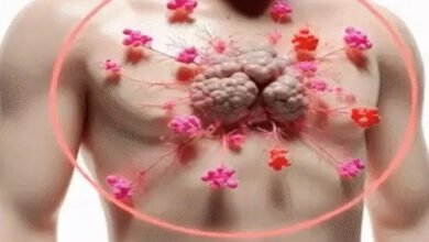 11 साल के बच्चे को रेयर थायमिक कैंसर से मिली नई जिंदगी, जटिल सर्जरी और थेरेपी से हुआ सफल इलाज 3 image 36